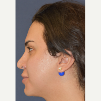 25-34 year old woman treated with Juvederm before 3549378