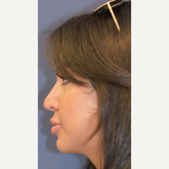 25-34 year old woman treated with Juvederm after 3549378