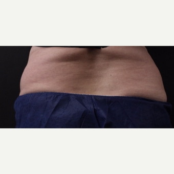 59 year old woman treated with CoolSculpting before 3384616