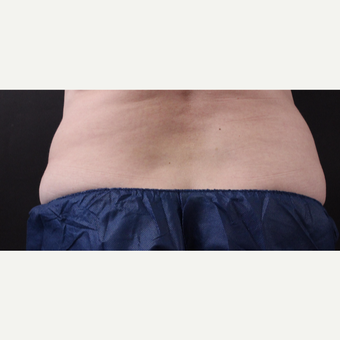 59 year old woman treated with CoolSculpting after 3384616