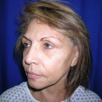 Facelift treatment before 3737766