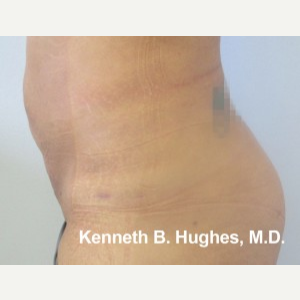 Liposuction after 3094219