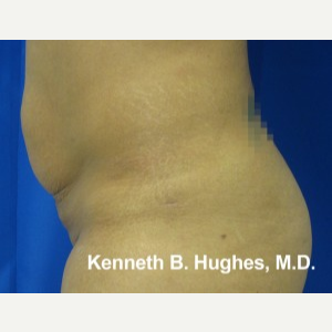 Liposuction before 3094219