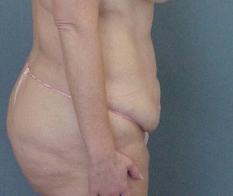 35-44 year old woman treated with Tummy Tuck before 3289642