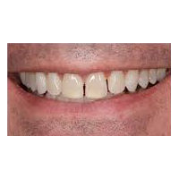 35-44 year old man treated with Lip Augmentation before 2986716