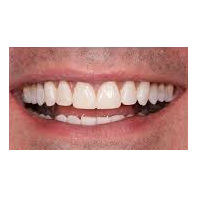 35-44 year old man treated with Lip Augmentation after 2986716