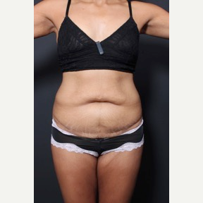 25-34 year old woman treated with Tummy Tuck before 3010614