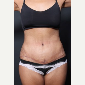 25-34 year old woman treated with Tummy Tuck after 3010614