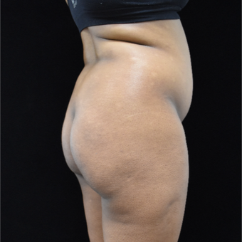 25-34 year old woman treated with Brazilian Butt Lift before 3305120