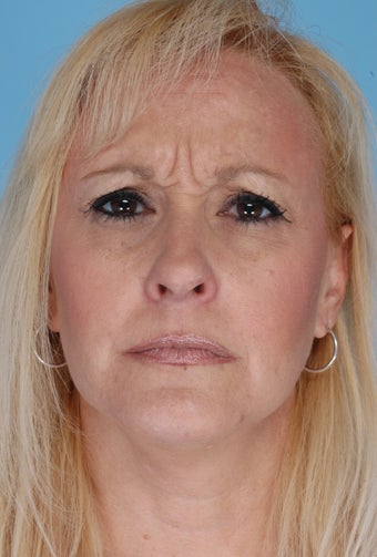 Botox before 506556