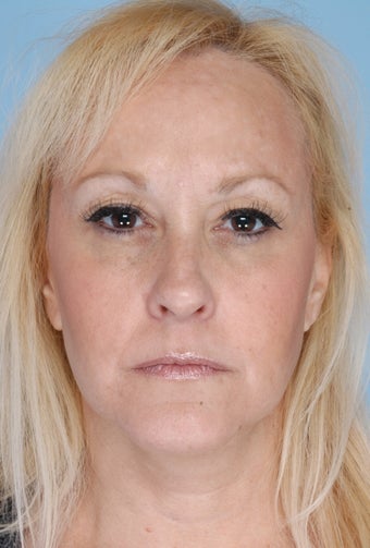 Botox after 506556