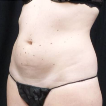 25-34 year old woman treated with truSculpt before 3424107