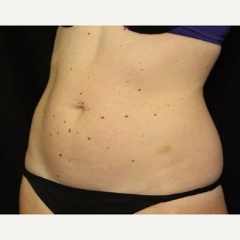 25-34 year old woman treated with truSculpt after 3424107