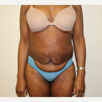Tummy Tuck before 3417712