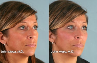Voluma on midface / cheeks after 1357856