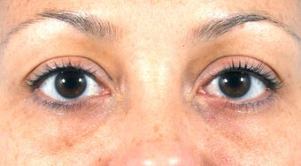 Filler for Under-eye circles (tear troughs) before 936982