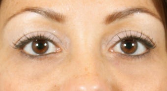 Filler for Under-eye circles (tear troughs) after 936982