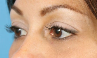 Filler for Under-eye circles (tear troughs) 936982