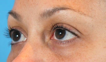 Filler for Under-eye circles (tear troughs) 936982