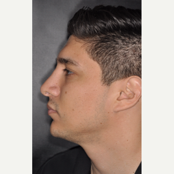 25-34 year old man treated with Rhinoplasty 3 years post-op after 3814046