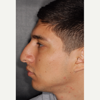 25-34 year old man treated with Rhinoplasty 3 years post-op before 3814046
