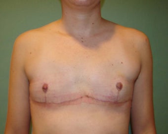 FTM "Top Surgery" after 867213