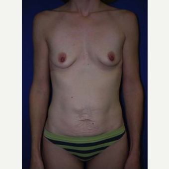 Breast Augmentation before 3744198