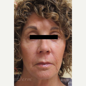 65-74 year old woman treated with Fractional Laser after 3607981