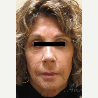 65-74 year old woman treated with Fractional Laser before 3607981