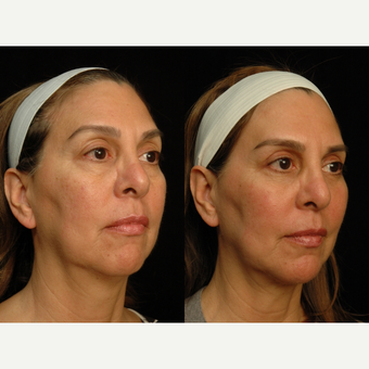 55-64 year old woman treated with Fat Transfer after 3659230