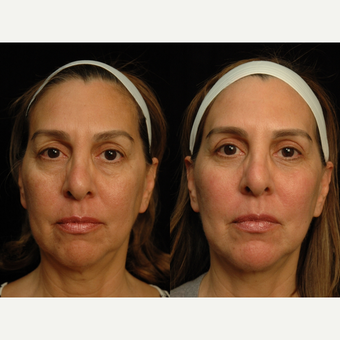 55-64 year old woman treated with Fat Transfer before 3659230