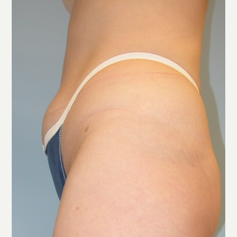35-44 year old woman treated with Liposuction before 3056240