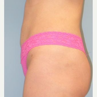 35-44 year old woman treated with Liposuction after 3056240