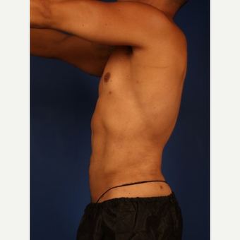 Liposuction after 3743848