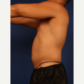 Liposuction before 3743848