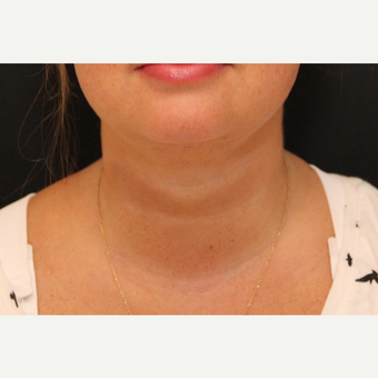 Chin Liposuction after 3611217