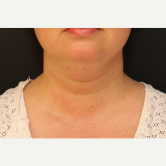 Chin Liposuction before 3611217