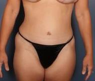 After Weight Loss, Breast Asymmetry, Breast lift with implants, Mommy Makeover, Tummy Tuck after 1359127