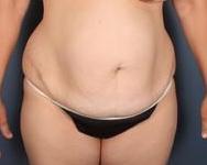 After Weight Loss, Breast Asymmetry, Breast lift with implants, Mommy Makeover, Tummy Tuck before 1359127