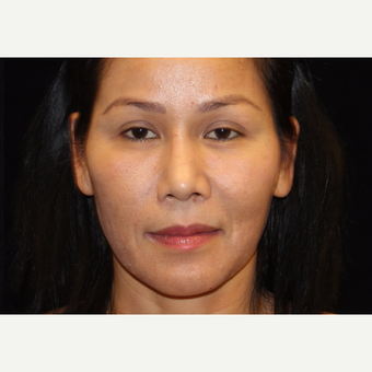 35-44 year old woman treated with Liquid Facelift after 3502992