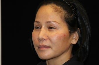 35-44 year old woman treated with Liquid Facelift 3502992