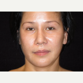 35-44 year old woman treated with Liquid Facelift before 3502992