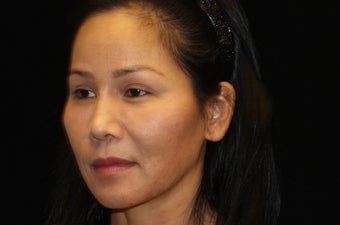 35-44 year old woman treated with Liquid Facelift 3502992
