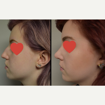 17 or under year old woman treated with Rhinoplasty before 3837358