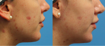 26 Year old Female Vi Peel before 1129696