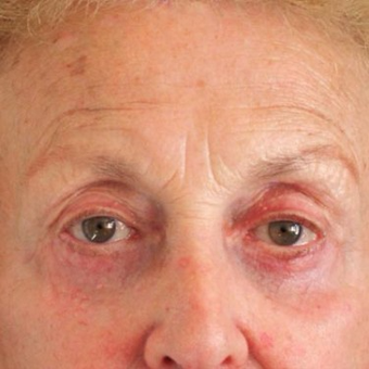 65-74 year old man treated with Eyelid Surgery after 3497030