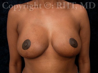 Breast Lift (mastopexy) after 254078