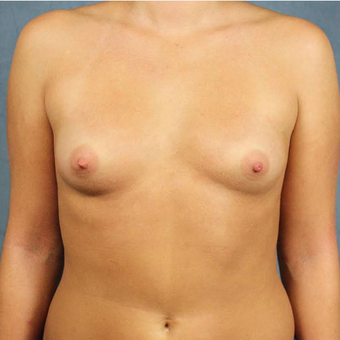 Mentor Breast Implants before 3033464