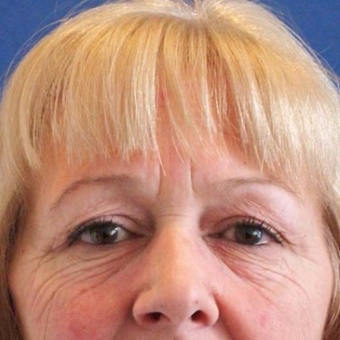 45-54 year old woman treated with Eyelid Surgery before 3497021