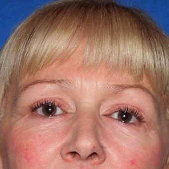 45-54 year old woman treated with Eyelid Surgery after 3497021
